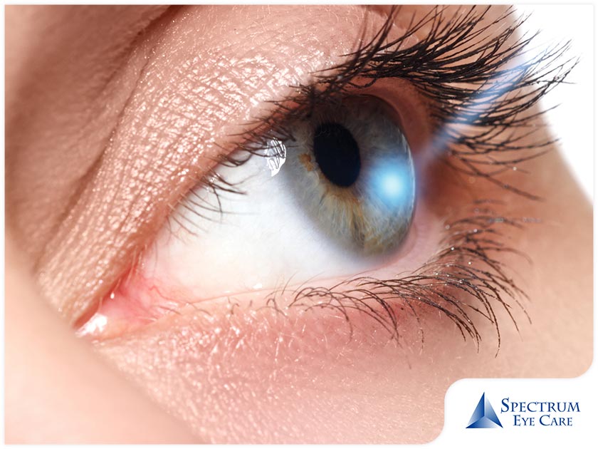 LASIK procedure being performed quickly